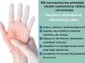 Dłoń z zaznaczonymi nerwami, ilustrująca ból neuropatyczny kręgosłupa. Odczuwany jako palący, piekący, z mrowieniem i drętwieniem.