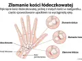 Ilustracja pokazuje złamanie kości łódeczkowatej nadgarstka, z zaznaczonymi miejscami pęknięcia: dalszym, trzonu i bliższym.