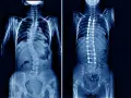 Rentgen klatki piersiowej przed i po operacji skoliozy. Widoczny kręgosłup z implantami stabilizującymi.