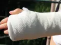 Ręka w gipsie po złamaniu kości księżycowatej.