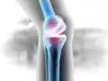 Anatomia kolana z widocznym bólem w stawie, wskazującym na chondromalację 2 stopnia.
