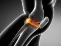 Anatomia kolana z widoczną uszkodzoną łąkotką, obraz rezonans.