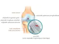 Anatomia kolana z zaznaczonym zerwanym więzadłem krzyżowym przednim (ACL). Leczenie zerwanego więzadła krzyżowego ile trwa?