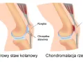 Porównanie zdrowego stawu kolanowego z chondromalacją rzepki, gdzie chrząstka stawowa jest uszkodzona.