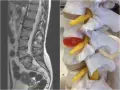 MRI kręgosłupa lędźwiowego i model anatomiczny ukazują ucisk na worek oponowy, który może powodować objawy neurologiczne.