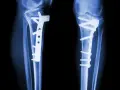 RTG kolan po zabiegu osteotomii guzowatości kości piszczelowej. Widoczne zespolenia płytami i śrubami.