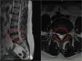 MRI kręgosłupa lędźwiowego z zaznaczoną przepukliną. Czy przepuklina kręgosłupa jest groźna? Obraz pokazuje, że tak, może uciskać nerwy.
