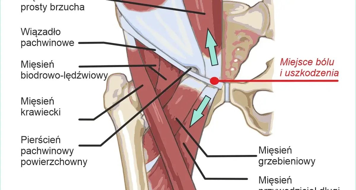 Anatomia pachwiny z zaznaczonym miejscem bólu i uszkodzenia, gdzie mięsień przywodziciel długi może być narażony.