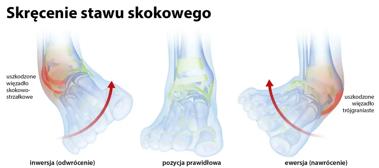 Ilustracja pokazuje inwersję stopy, czyli odwrócenie, które prowadzi do uszkodzenia więzadła skokowo-strzałkowego. Obok prawidłowa pozycja i ewersja.