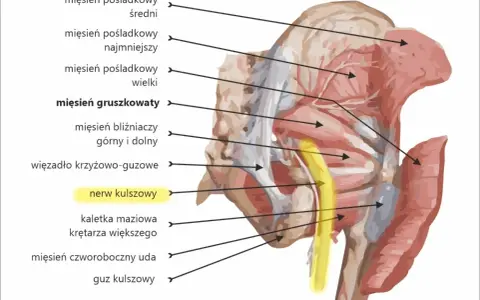 Anatomia miednicy: wbicie igły w nerw kulszowy, przebiegający obok mięśnia gruszkowatego.
