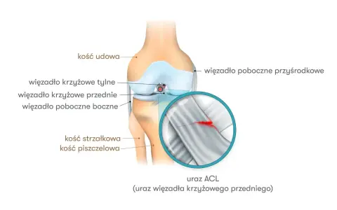 Ilustracja przedstawia anatomię kolana z zaznaczonym zerwanym więzadłem krzyżowym przednim (ACL). Objawy zerwania przeszczepu ACL mogą być widoczne na powiększonym fragmencie.