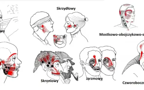 Punkty spustowe w obrębie stawów skroniowo żuchwowych: policzkowy, skrzydłowy, żwacz, skroniowy, jarzmowy, mostkowo-obojczykowo-sutkowy, czworoboczny.