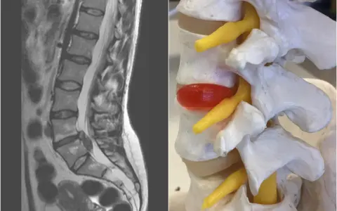 MRI kręgosłupa lędźwiowego i model anatomiczny ukazują ucisk na worek oponowy, który może powodować objawy neurologiczne.