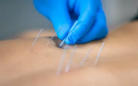 Dłoń w niebieskiej rękawiczce aplikuje igły do akupunktury, która pomaga w łagodzeniu bólu i poprawie samopoczucia.