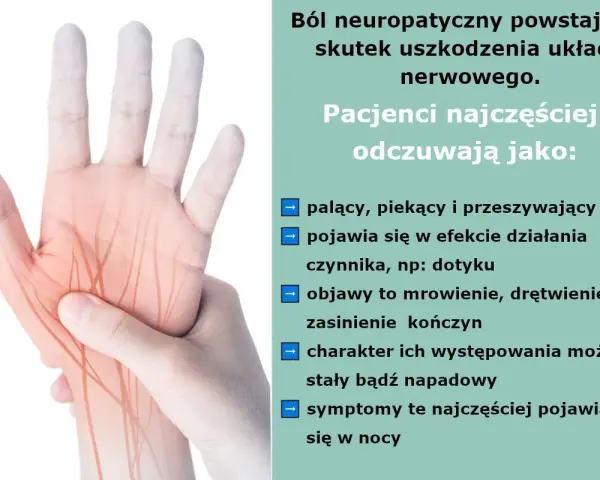 Dłoń z zaznaczonymi nerwami, ilustrująca ból neuropatyczny kręgosłupa. Odczuwany jako palący, piekący, z mrowieniem i drętwieniem.