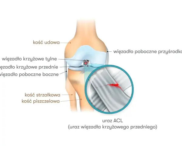 Ilustracja przedstawia anatomię kolana z zaznaczonym zerwanym więzadłem krzyżowym przednim (ACL). Objawy zerwania przeszczepu ACL mogą być widoczne na powiększonym fragmencie.