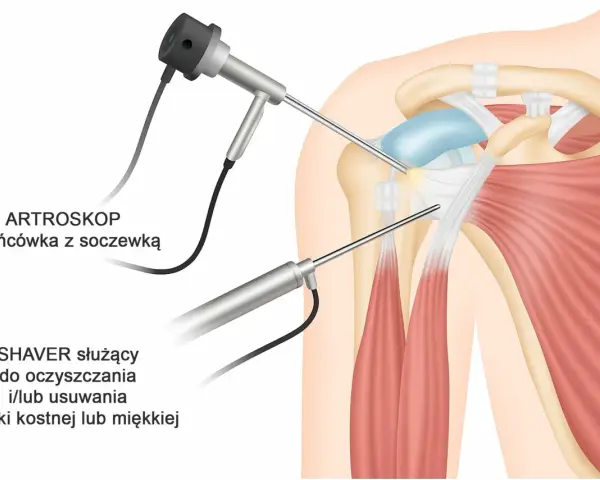 Artroskop i shaver w trakcie zabiegu barku, pomagające w diagnostyce i leczeniu bolesnego łuku.