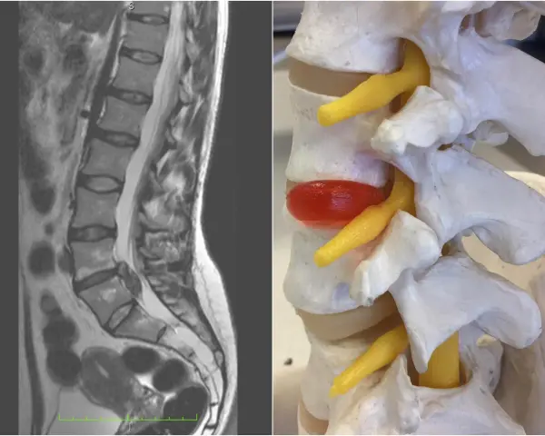 MRI kręgosłupa lędźwiowego i model anatomiczny ukazują ucisk na worek oponowy, który może powodować objawy neurologiczne.