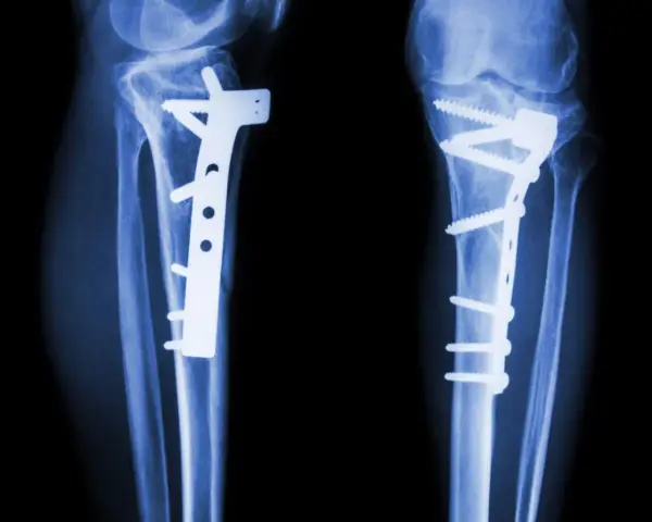 RTG kolan po zabiegu osteotomii guzowatości kości piszczelowej. Widoczne zespolenia płytami i śrubami.