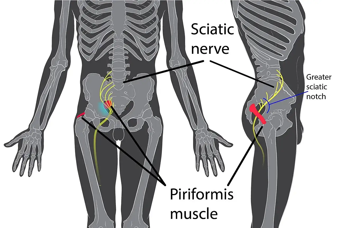 Anatomia miednicy z zaznaczonym nerwem kulszowym i mięśniem gruszkowatym. Zespół mięśnia gruszkowatego może powodować ucisk na nerw.