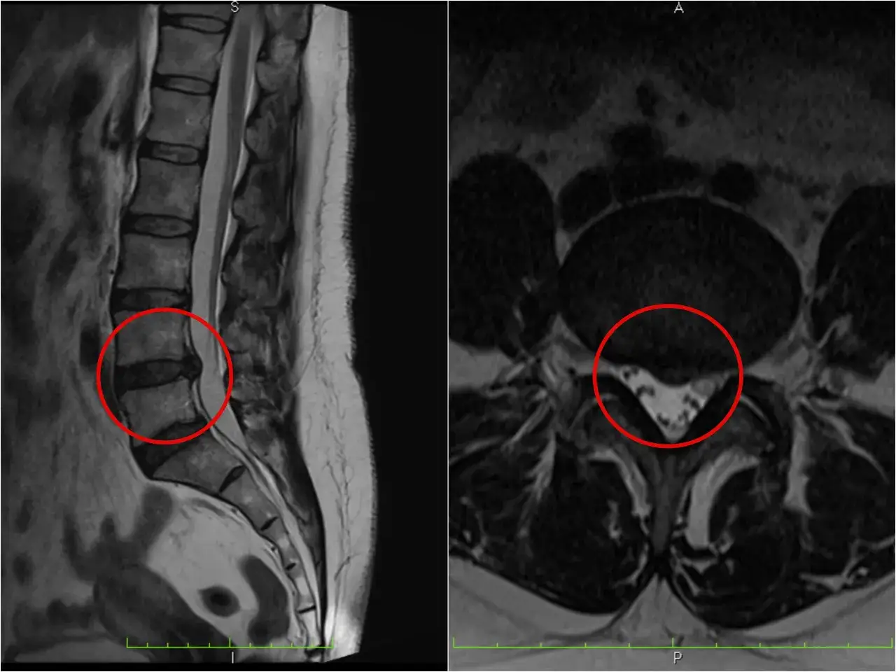 Widoczne badanie MRI kręgosłupa lędźwiowego z zaznaczoną szerokopodstawną wypukliną krążka międzykręgowego.