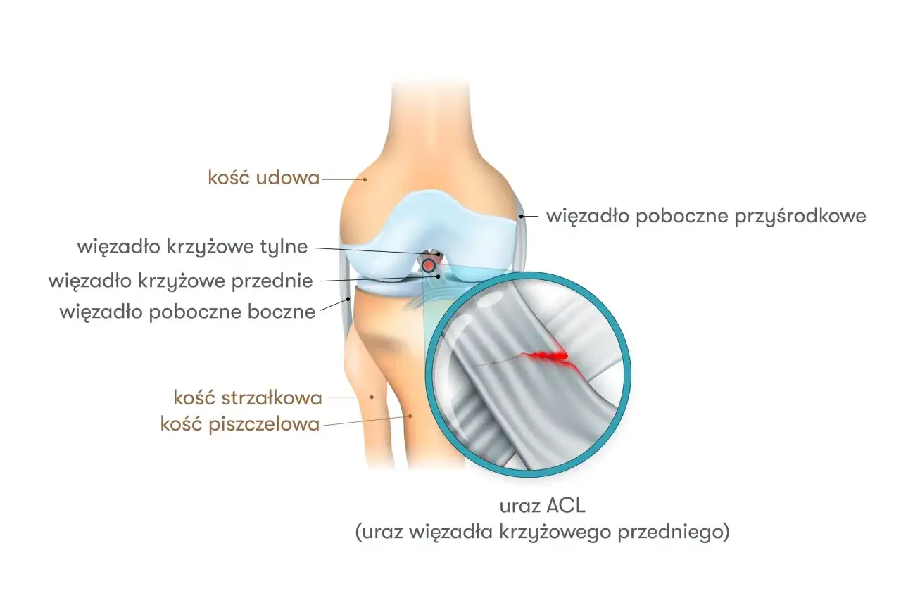 Anatomia kolana z zaznaczonym urazem ACL (przedniego więzadła krzyżowego). Widoczny pęknięty włókna więzadła.