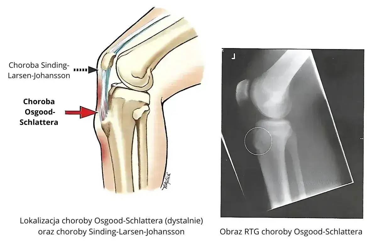 Ilustracja anatomiczna i RTG kolana pokazujące lokalizację choroby Osgood-Schlattera. Unikaj nadmiernego obciążania stawu.